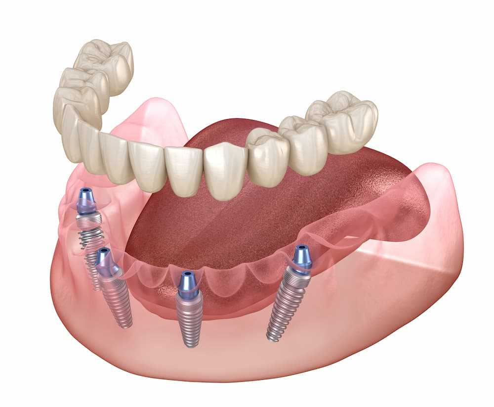 All-on-4 treatment concept - Leading Implant Centers