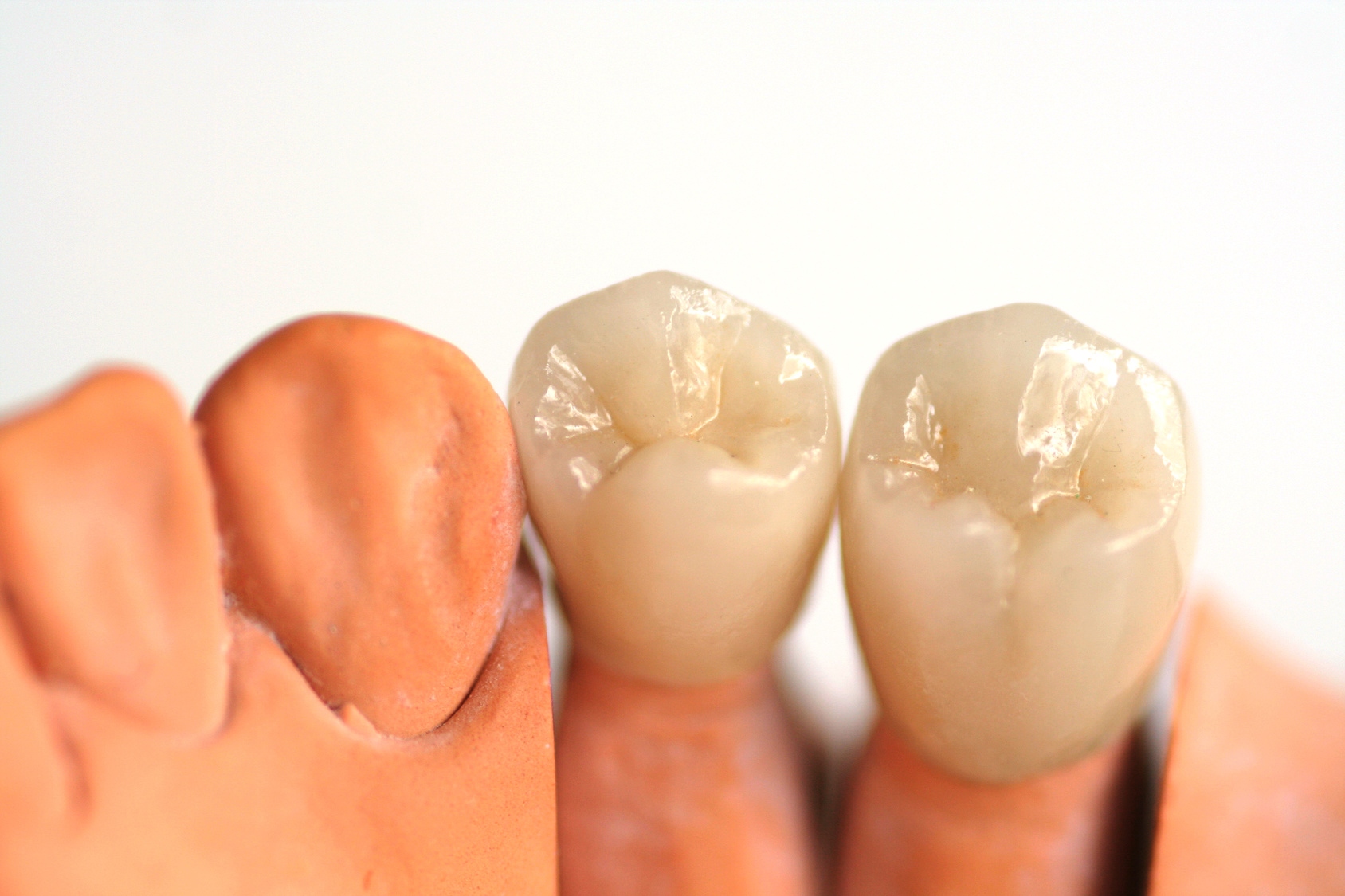 Zahnkrone Keramikaufsatz Auf Dem Zahnstumpf