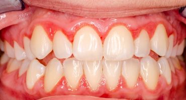 Gingivitis (Zahnfleischentzündung)
