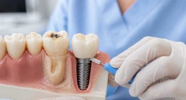 Can a Dental Implant Get Cavities? What You Need to Know About Implants