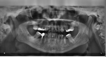 Streitpunkt Amalgam-Zahnfüllungen
