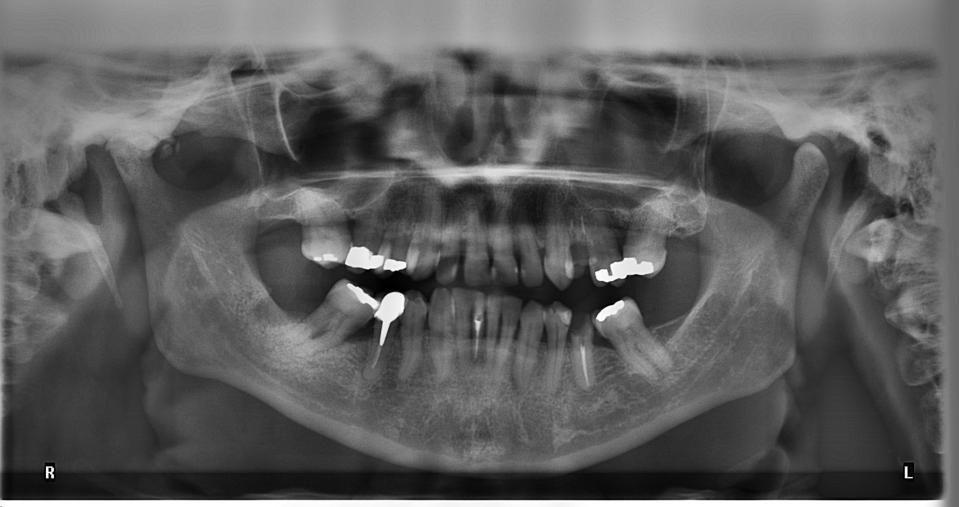 Issue Amalgam Tooth Fillings